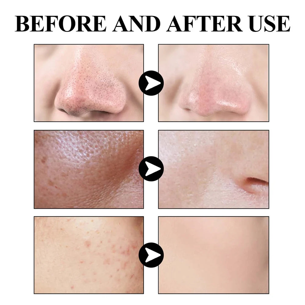 West & Month Blackhead Removal Mud Mask for Oil Control